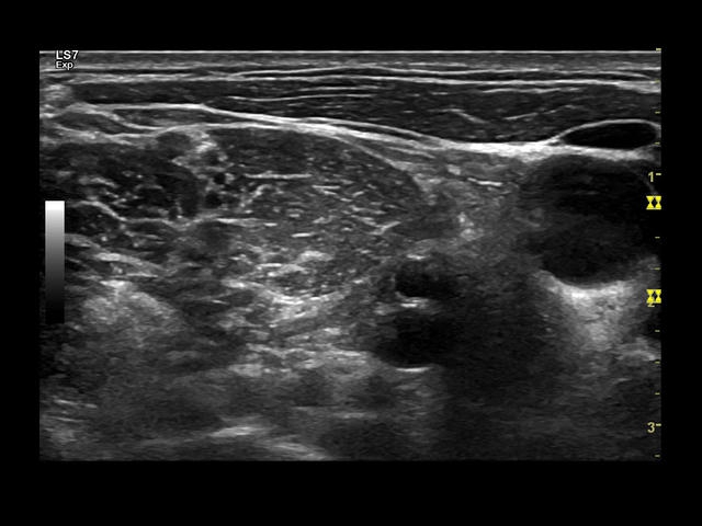 GE Logiq S7 с XDClear